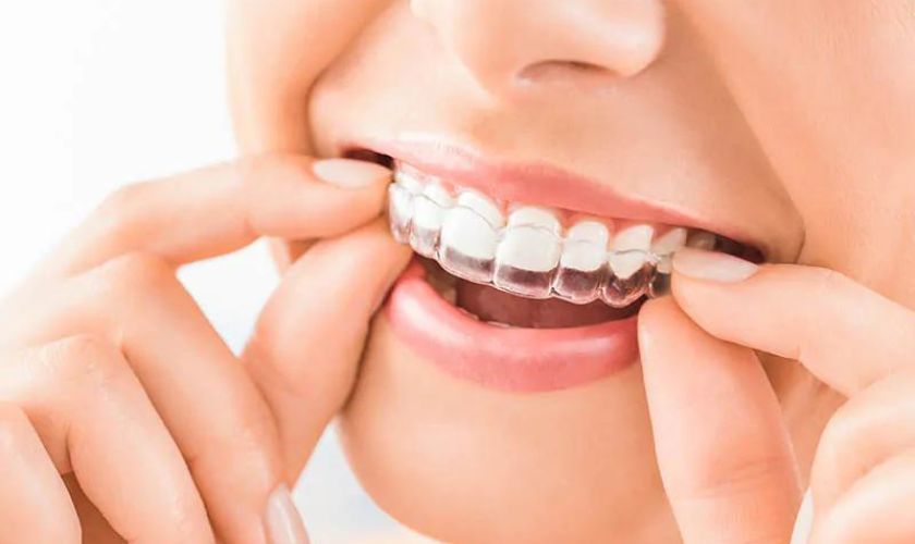 Clear Aligners in Dallas