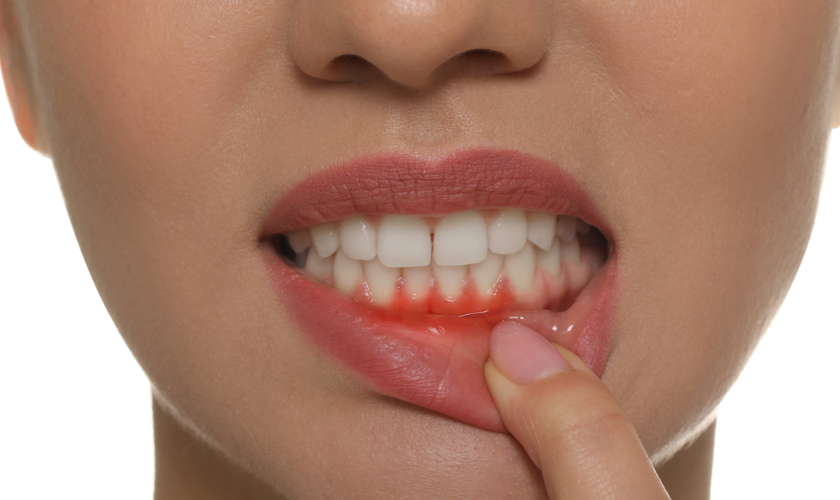 Gum Disease Treatment