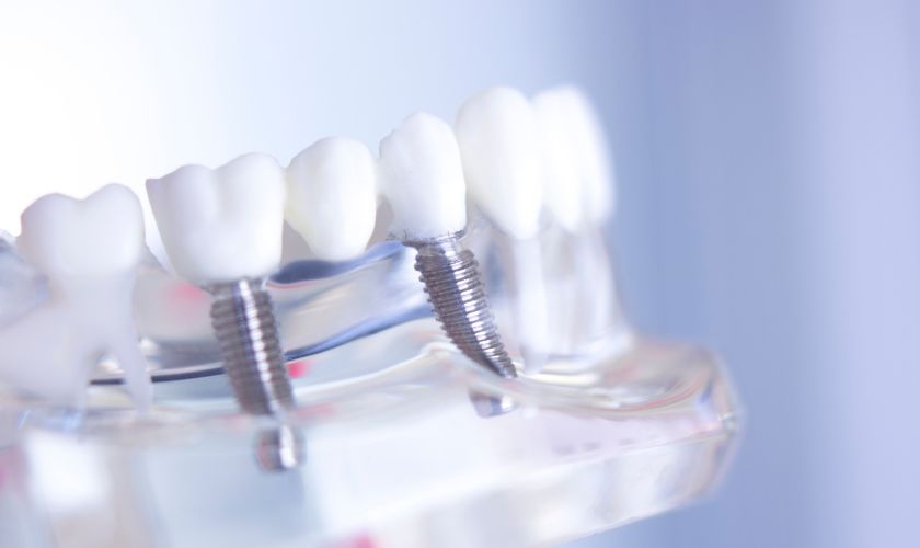 Dental Implant