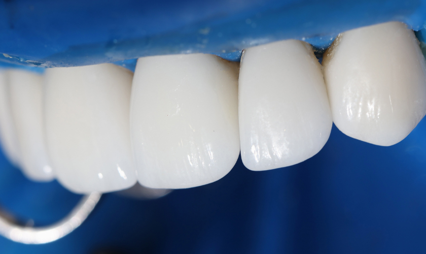 Choosing The Right Veneers Dentist: Key Considerations For A Perfect Smile