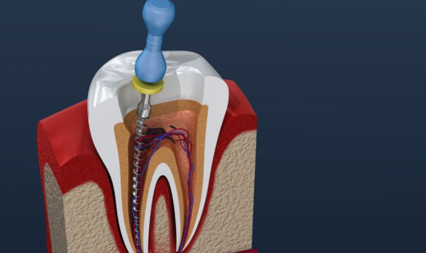 Root Canal Recovery: What To Expect After Treatment In Dallas