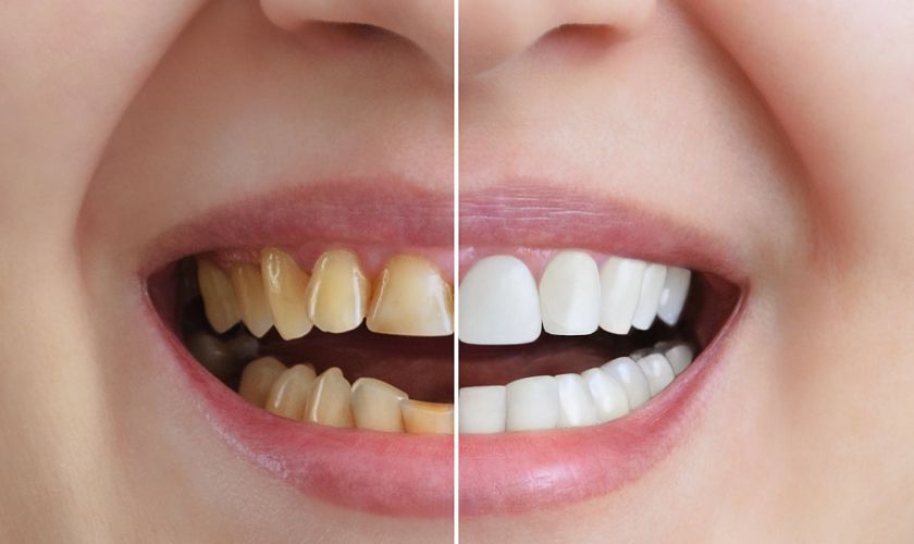 The Science Of Teeth Whitening: Understanding The Process In Dallas