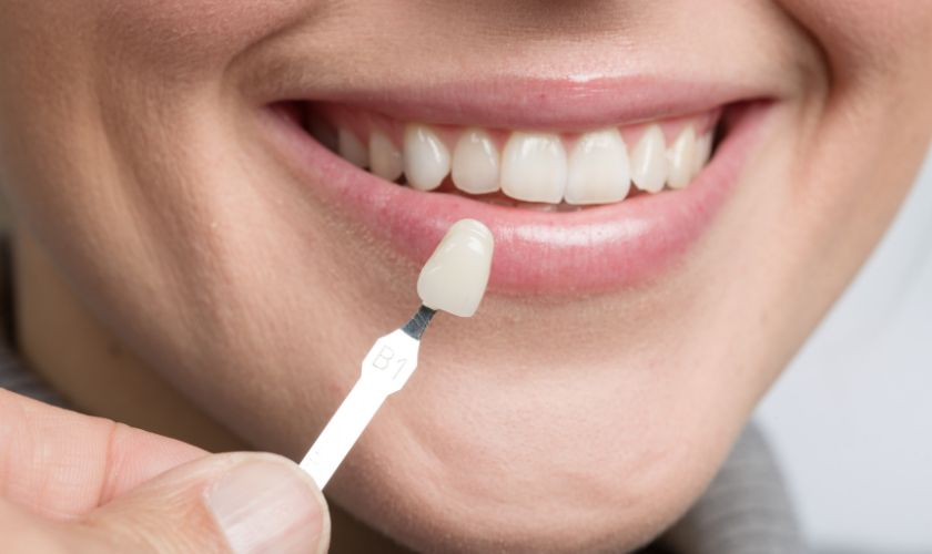 Porcelain Veneers in Dallas