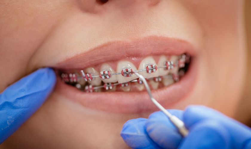 braces