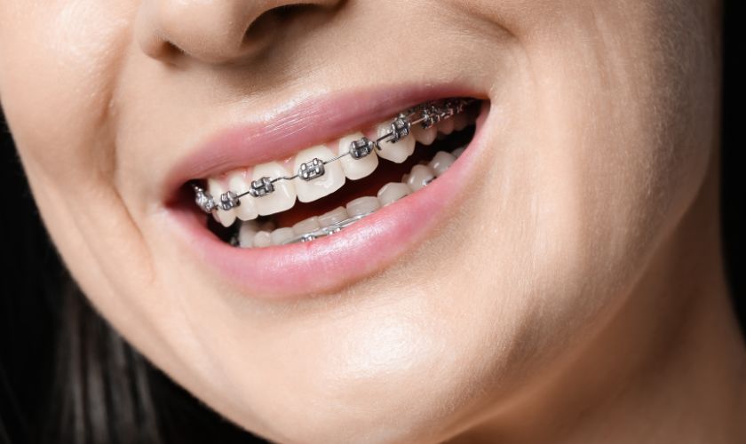 braces
