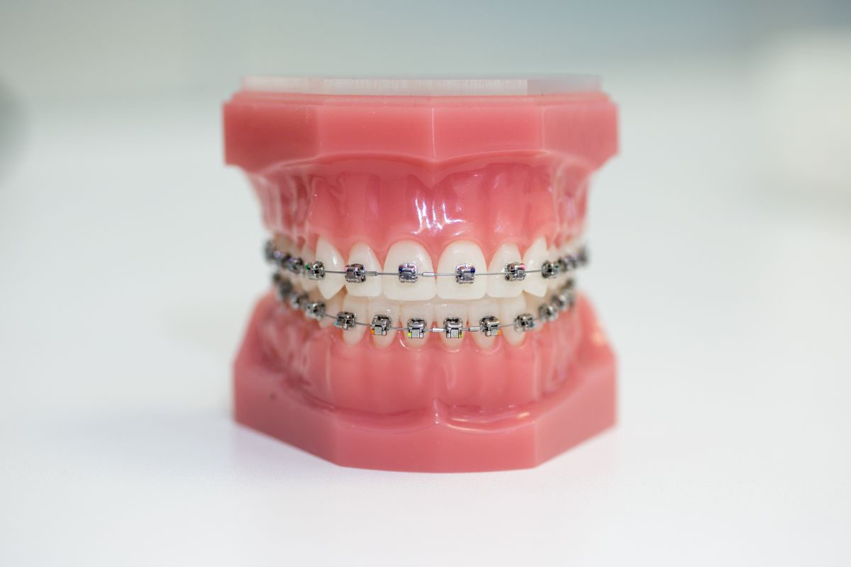 Braces Dallas, TX