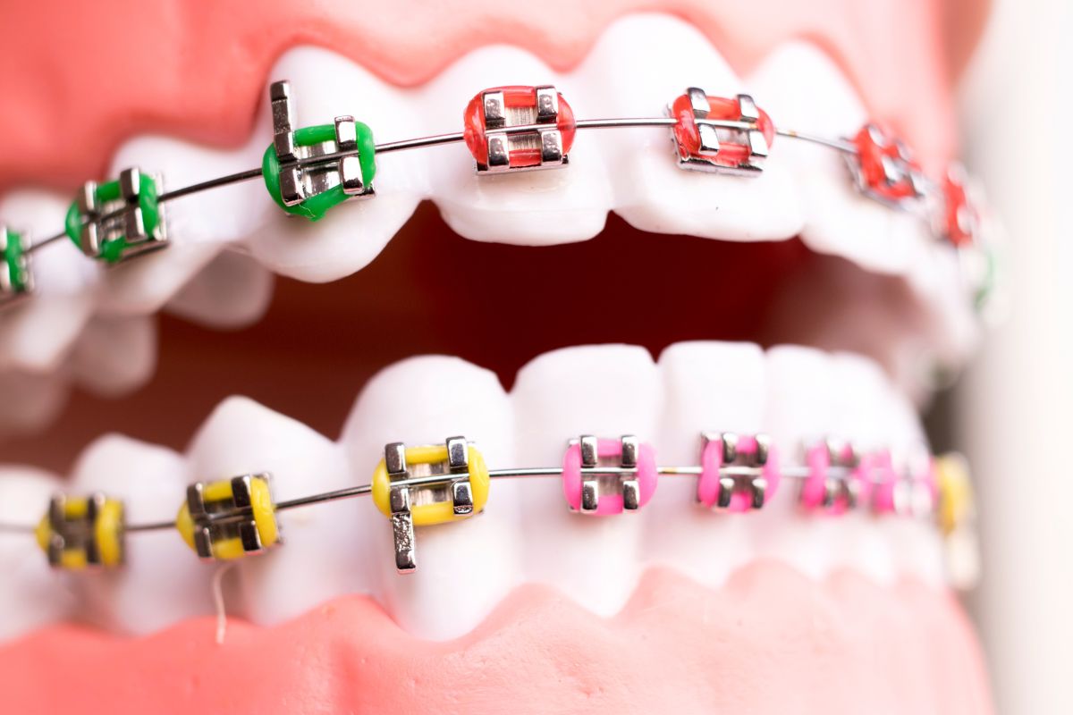 Braces Dallas