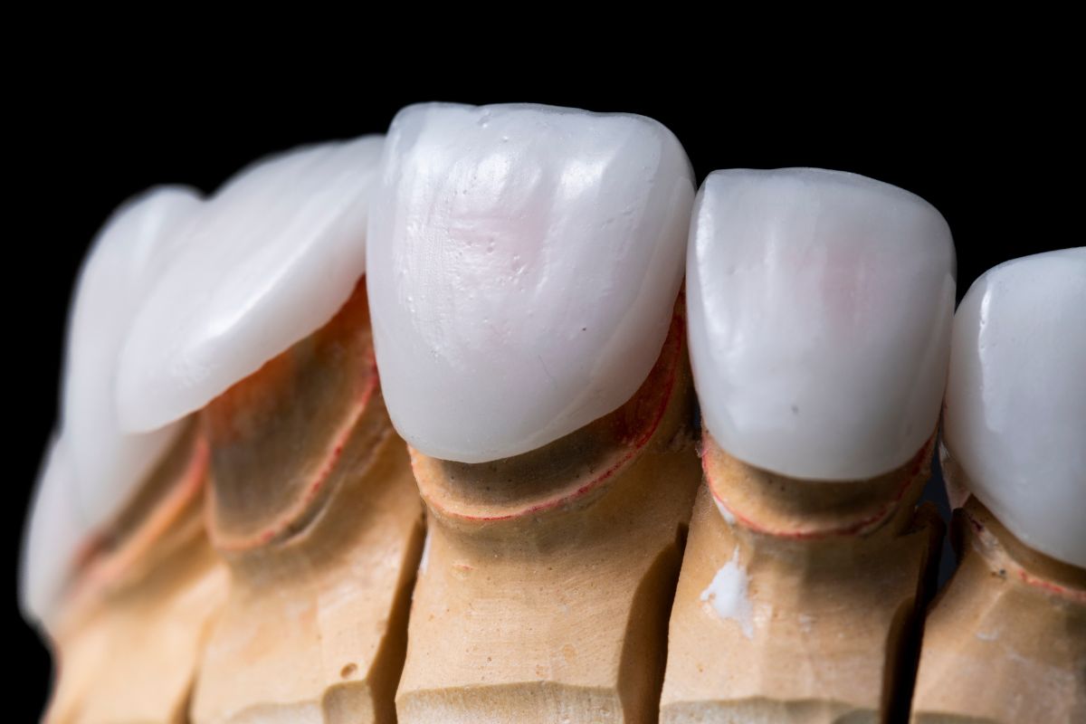 Porcelain Dental Veneers in Dallas