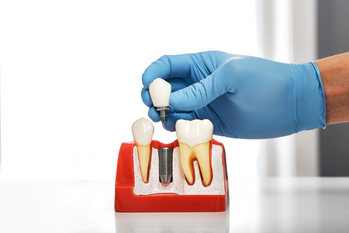 Dental Implants in Dallas
