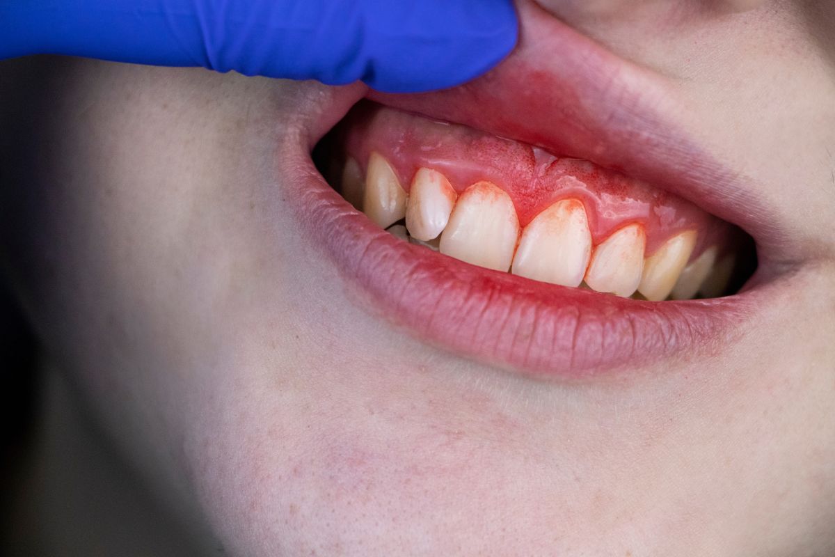 Periodontal Maintenance in Dallas