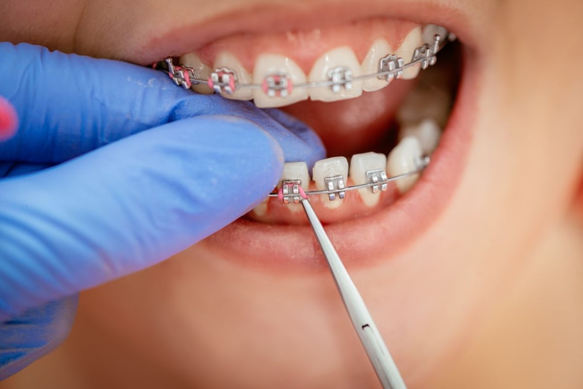 Braces in Dallas