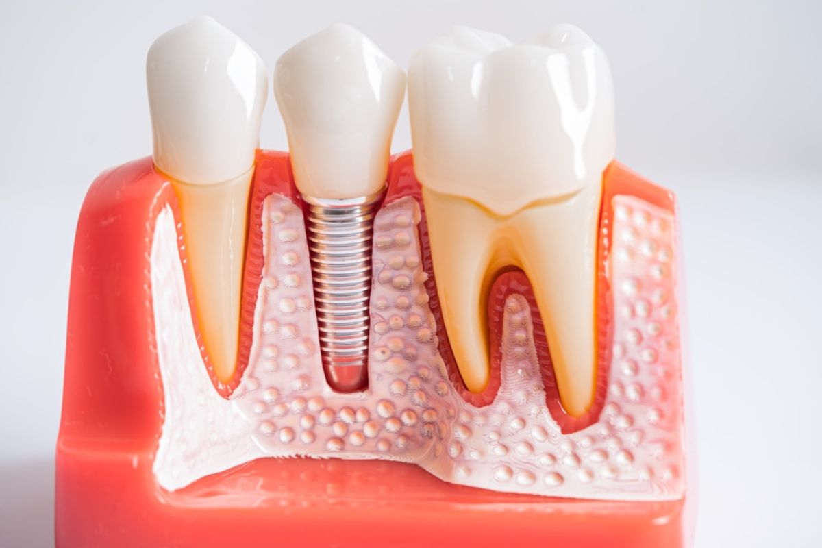 Dental implants in Dallas