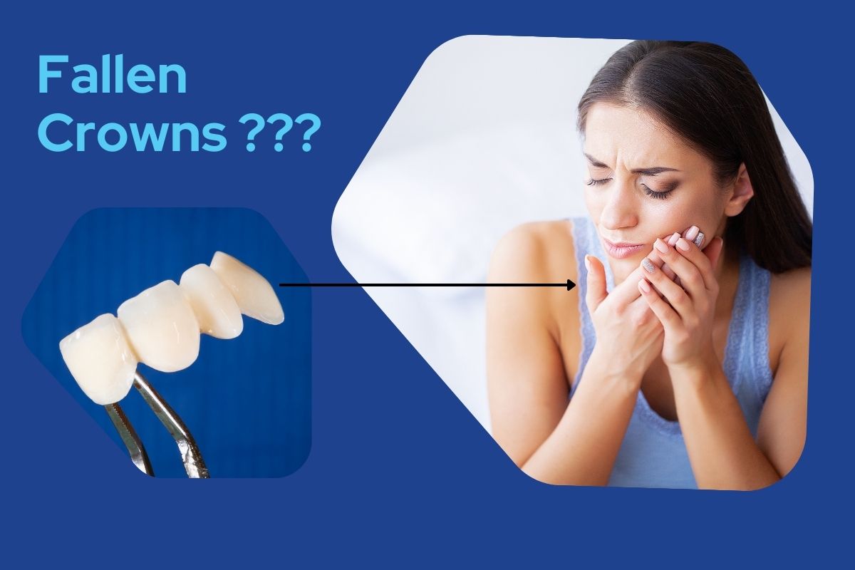 Fallen Dental Crowns