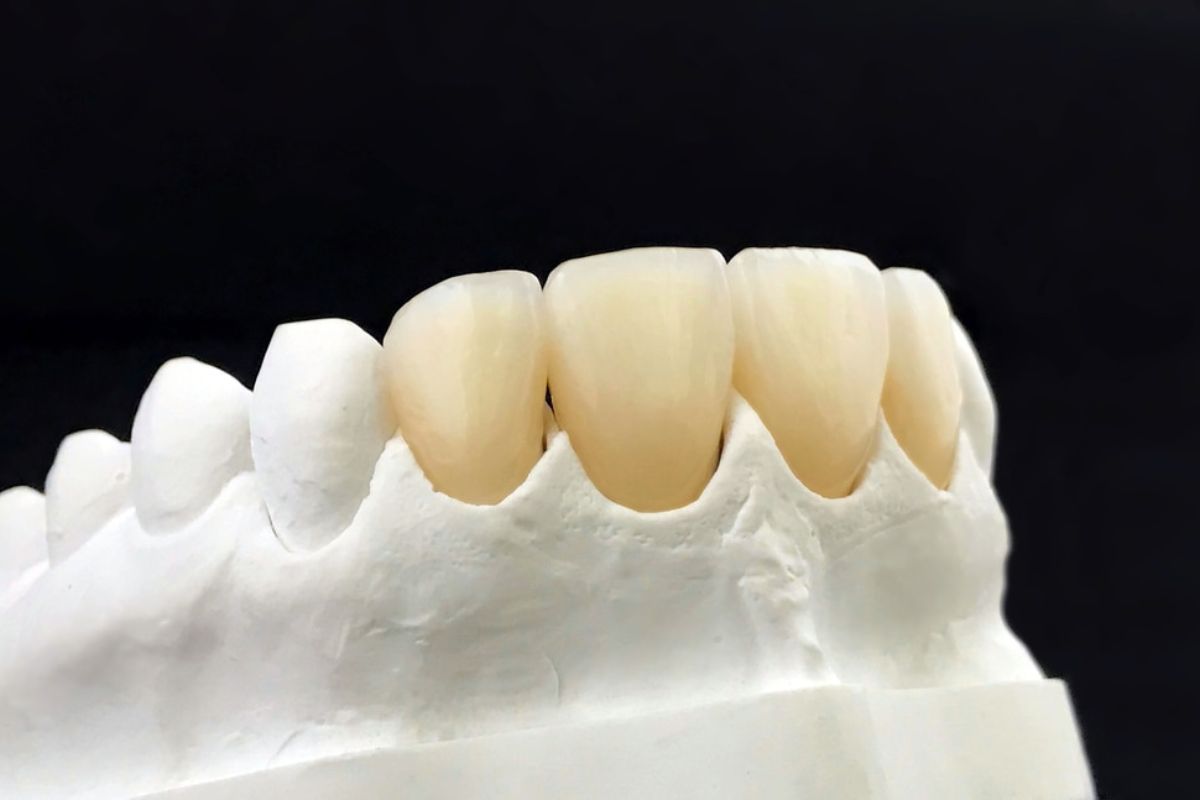 Porcelain Dental Crown Dallas